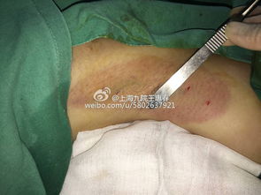 微切口 1厘米直視下腋臭根除術(shù) ,圖片幾張 手術(shù)