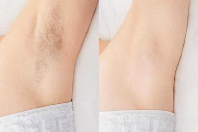 鄭州科大醫(yī)院腋臭專科:除臭就要與眾不同