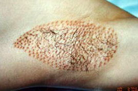 治療狐臭最佳年齡 專家為你解難題