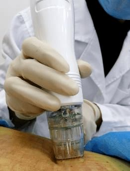 腋臭治療 寶點 ,兩袖清風不是夢