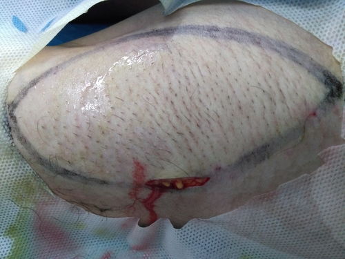 微創腋臭根治術