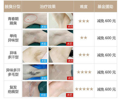 腋臭的搜索結果_圖片