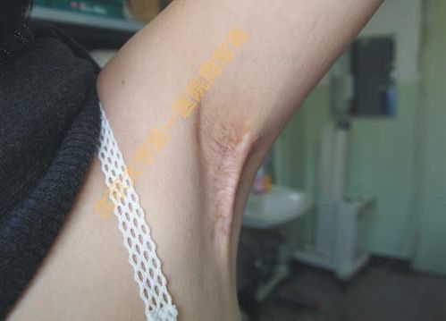 掃除一生的煩惱 微創腋臭根治術