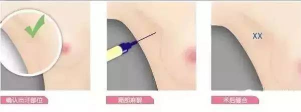 人民醫院:黃金微針腋臭治療儀,帶你告別夏季尷尬