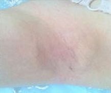 怎么治療狐臭好