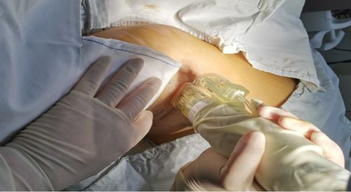 黃金微針治療腋臭,您了解嗎