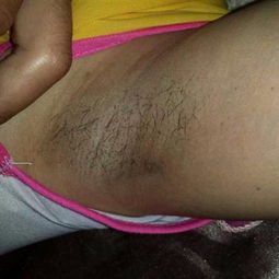 生活保健 其他疾病健康經驗分享 第22846頁 39問醫生 39健康網