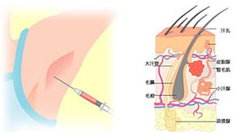 深圳微波一次性一次性祛腋臭 狐臭 治療腋臭狐臭方法技術醫院
