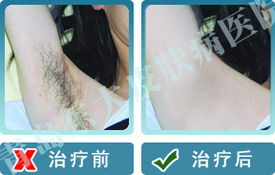 祛除身體異味，還你清香肌膚——威海皮膚病醫(yī)院專業(yè)治療狐臭