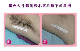 電離子去腋臭手術(shù)的原理、方法與治療優(yōu)勢